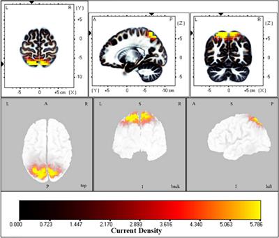 Open Eyes Increase Neural Oscillation and Enhance Effective Brain Connectivity of the Default Mode Network: Resting-State Electroencephalogram Research